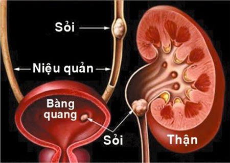 Sỏi bàng quang có thể phát hiện qua siêu âm