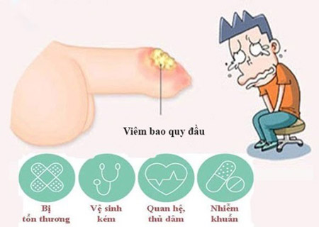 Viêm nhiễm nam khoa là dấu hiệu của bệnh viêm quy đầuViêm nhiễm nam khoa là dấu hiệu của bệnh viêm quy đầu