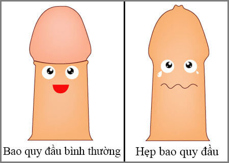 Hẹp bao quy đầu