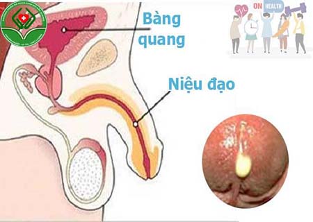 đi tiểu buốt chảy mủ