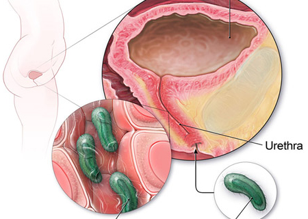 Nhiễm trùng đường tiết niệu có nhiều biểu hiện khác nhau