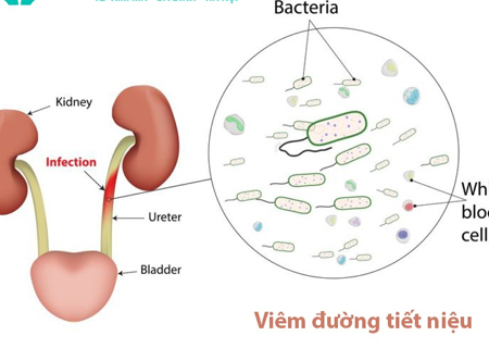 Viêm đường tiểu do nhiễm khuẩn