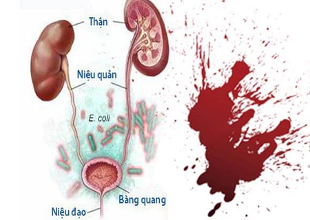 Viêm tiết niệu ra máu do nhiều nguyên nhân khác nhau