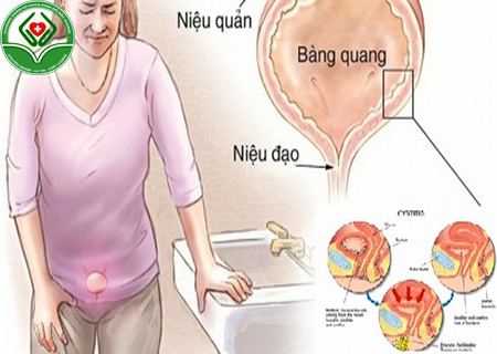 nhiễm khuẩn đường tiết niệu phụ nữ