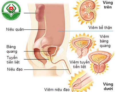 Viêm đường tiểu ở nam giới là gì?